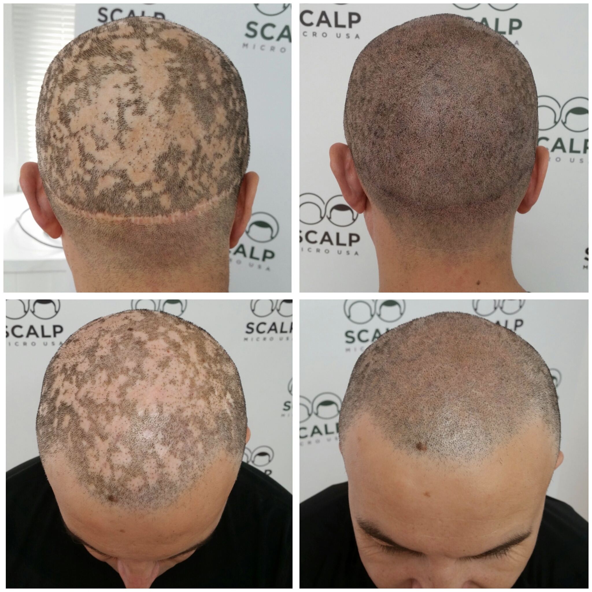 Scalp Micro Usa Hides An Alopecia Patient S Hair Loss With Unique Scalp